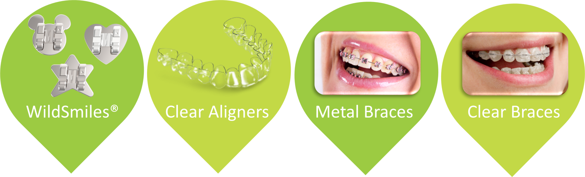 Clear Aligners vs Clear Braces